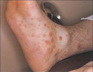 malaria rash